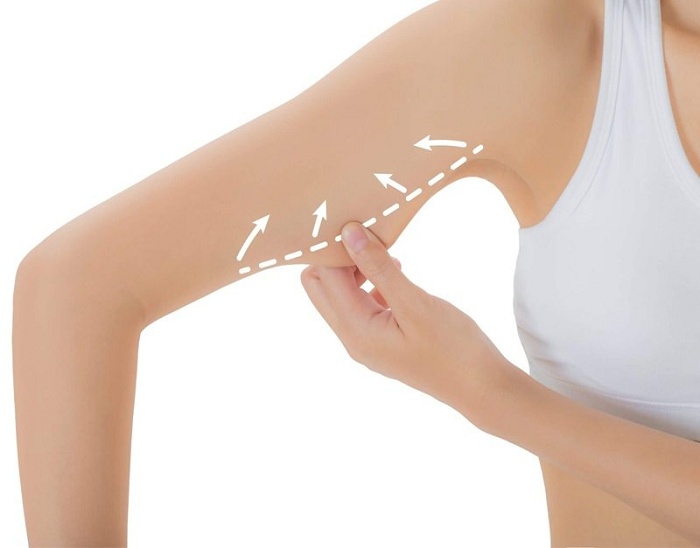 Giảm mỡ bắp tay không phẫu thuật
