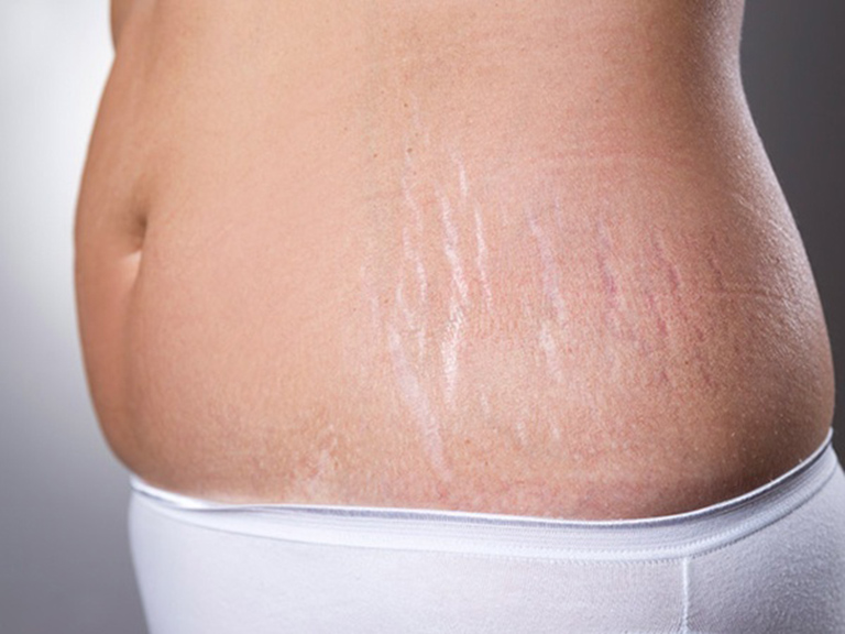 cách trị rạn da tại nhà an toàn và hiệu quả